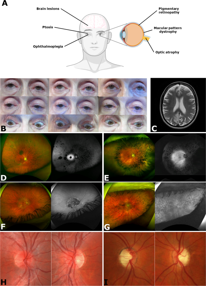 Eye Health Concerns Prompt Update on Recent Biopsy Following Abnormal Findings