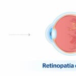 La relación entre el bajo nivel de azúcar en la sangre y el daño ocular en la retinopatía diabética: Un medicamento experimental muestra potencial en el tratamiento.