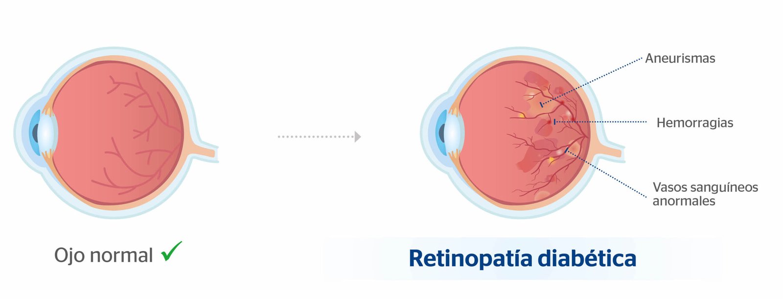 La relación entre el bajo nivel de azúcar en la sangre y el daño ocular en la retinopatía diabética: Un medicamento experimental muestra potencial en el tratamiento.