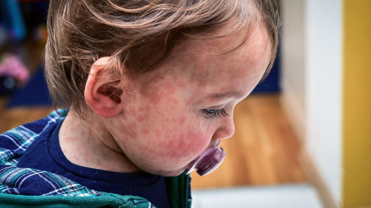 Measles cases are on the rise worldwide, prompting health authorities to intensify vaccination campaigns. In the United States, the Centers for Disease Control and Prevention (CDC) has deployed experts to Texas to manage a growing measles outbreak. Additionally, a child died of measles, and her parents appeared in an anti-vaccine video, highlighting the challenges in combating vaccine misinformation. (newsnow.com)