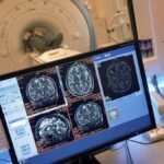 No se encuentra evidencia que respalde la “enfermedad cerebral misteriosa” en New Brunswick, según el estudio.