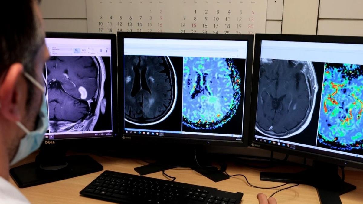 Pediatría de herramienta de inteligencia artificial ayuda a prevenir el cáncer cerebral